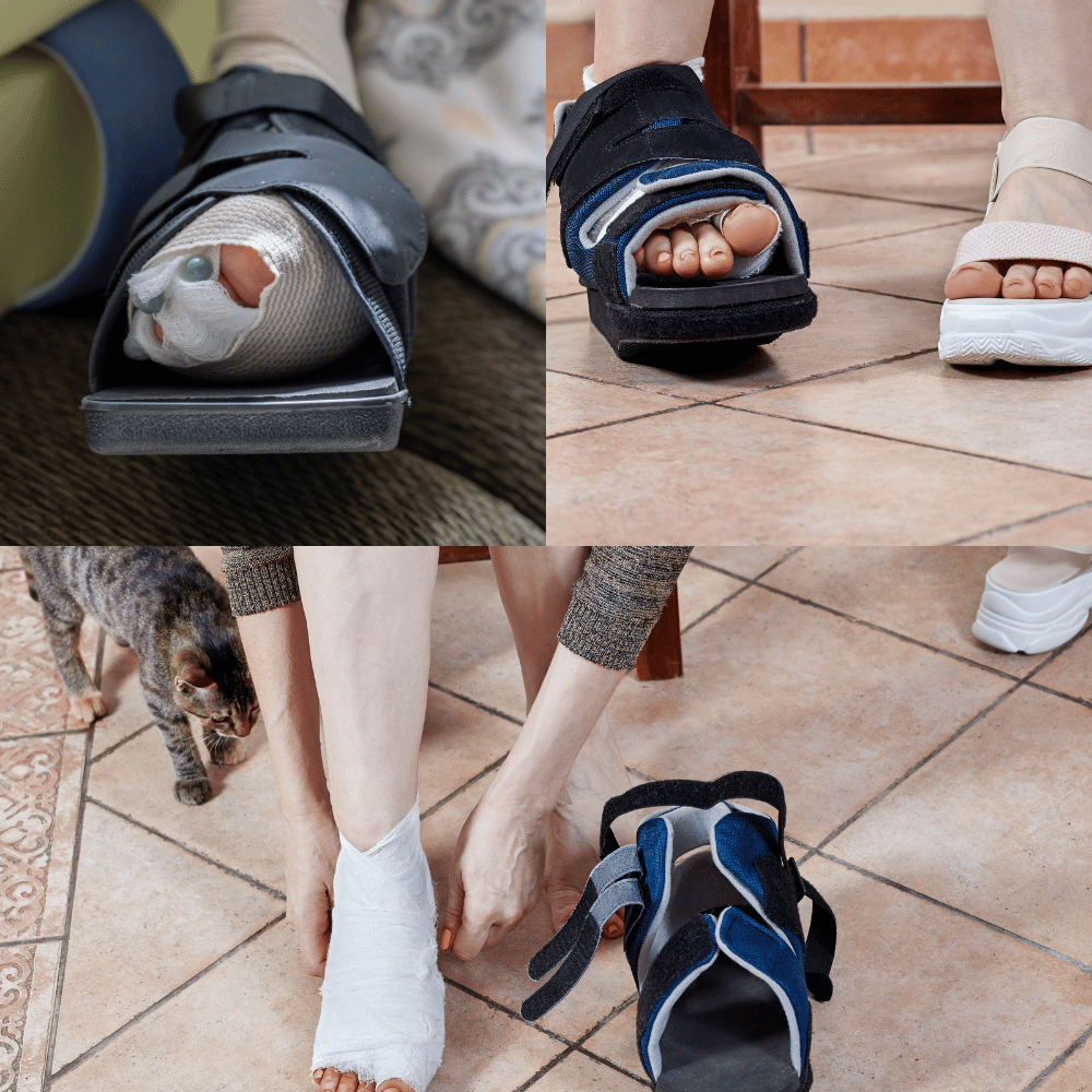 Stepping Up Your Recovery: The Top 3 Shoes for After Bunion Surgery